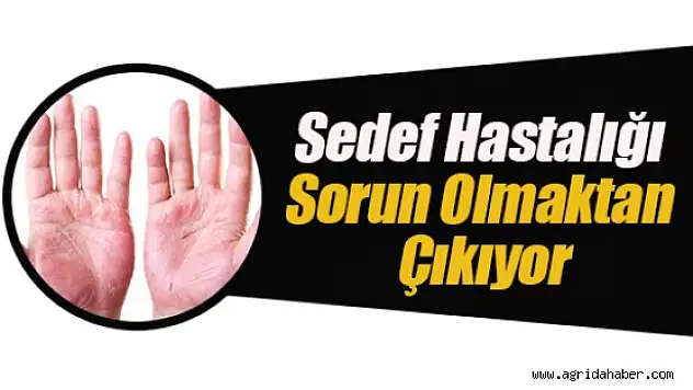 Sedef Hastalarına Müjde