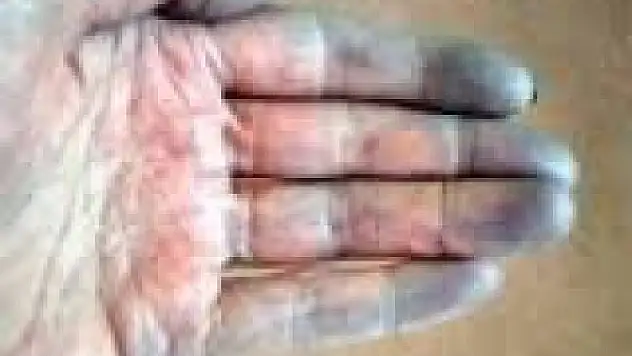 Raynaud Hastalığı