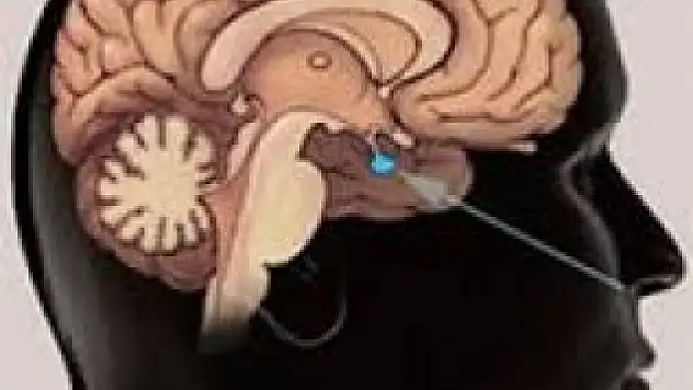 Hipofiz Adenomu