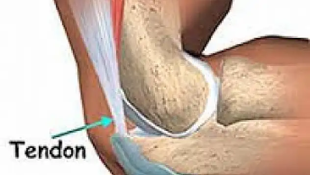 Tendinit (Tendon İltihabı)