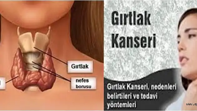 Gırtlak Kanseri