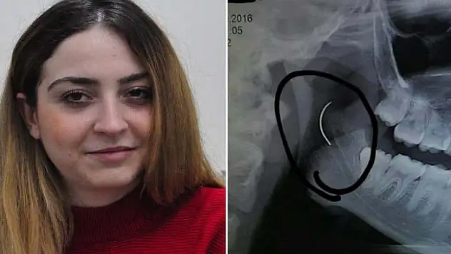 Boğazındaki iğneyle tam 18 yıl yaşadı