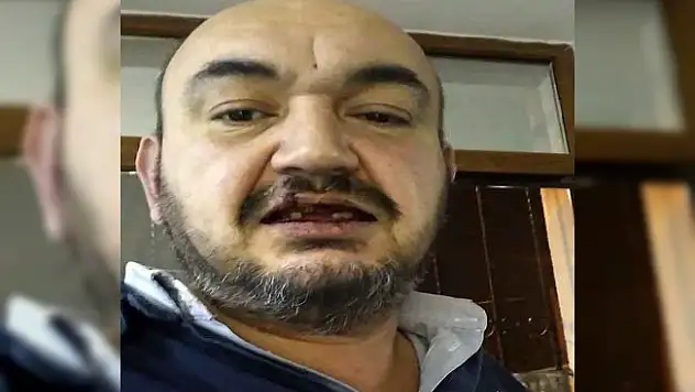 UBER sürücüsünün dişlerini kırdılar