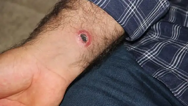 Şarbon Virüsü Nedir? Şarbon Hastalığı Nedir? Şarbon Hastalığı Belirtileri