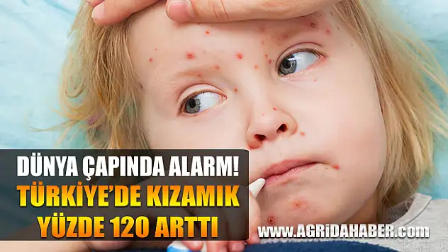 Dünya çapında kızamık Alarmı! Türkiye'de Kızamık Yüzde 120 Arttı