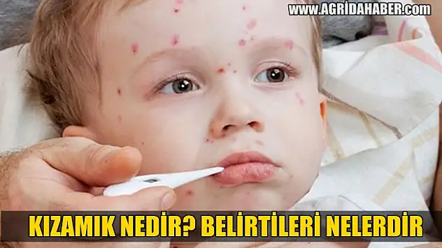 Kızamık nedir? Kızamık Belirtileri ve Tedavisi