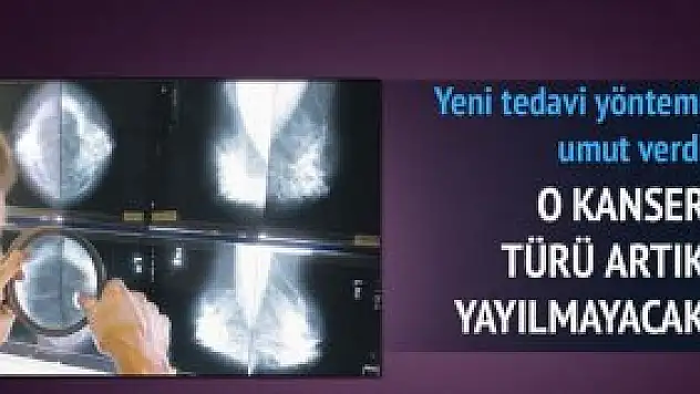 Göğüs kanserinde sıçrama engellendi