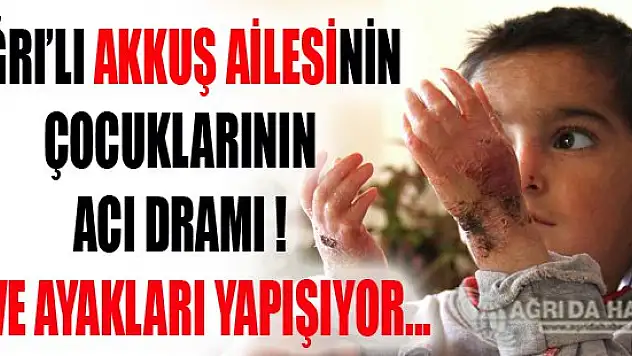AKKUŞ Kardeşlerin El Ve Ayak Parmakları Hastalık Yüzünden Yapışıyor!