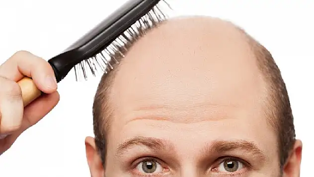 Saç dökülmesi nedir?Neden olur?