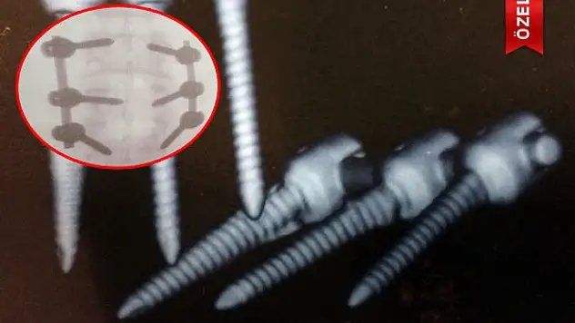 Omurga Ameliyatında İmitasyon Vida Kullanan Doktora Davası