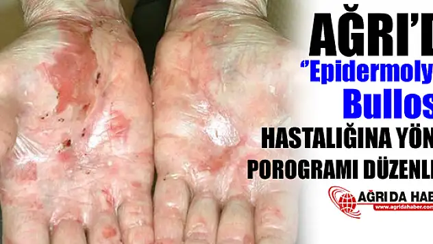 Ağrı'da Epidermolyssis Bullosa Hastalarına Yönelik Program Düzenlendi!