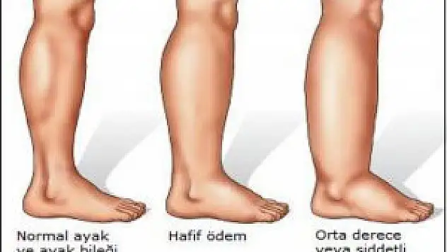Vücutta Oluşan Ödemleri Nasıl Atarız?