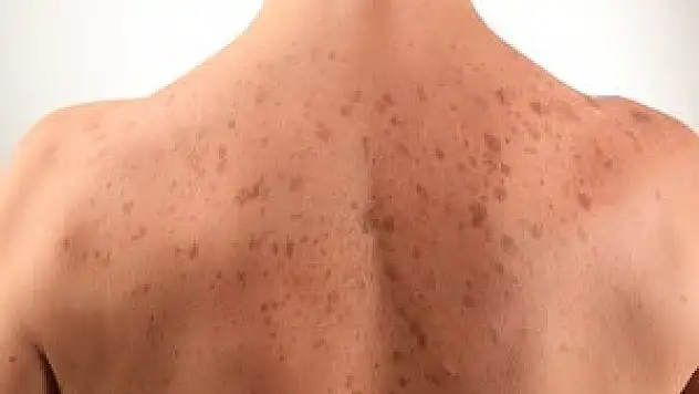 Ciltteki Lekeler Antibiyotikten Olabilir!