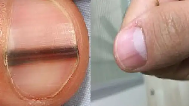 Tırnağında Bu Çizgi Olanlar Dikkat!