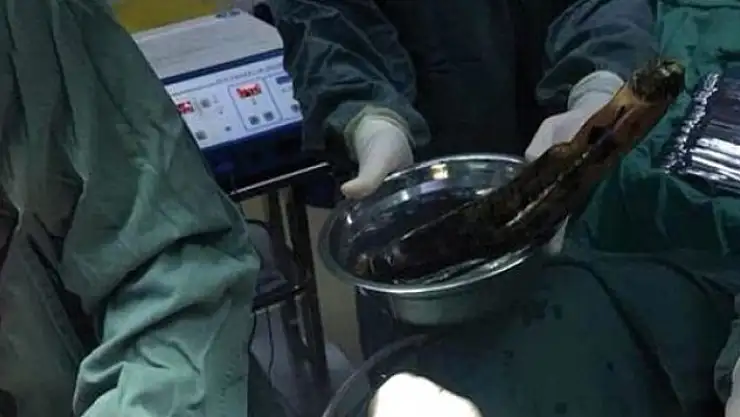 Karın Ağrısı İçin Gitti Karnından 30 Cm'lik Patlıcan Çıktı